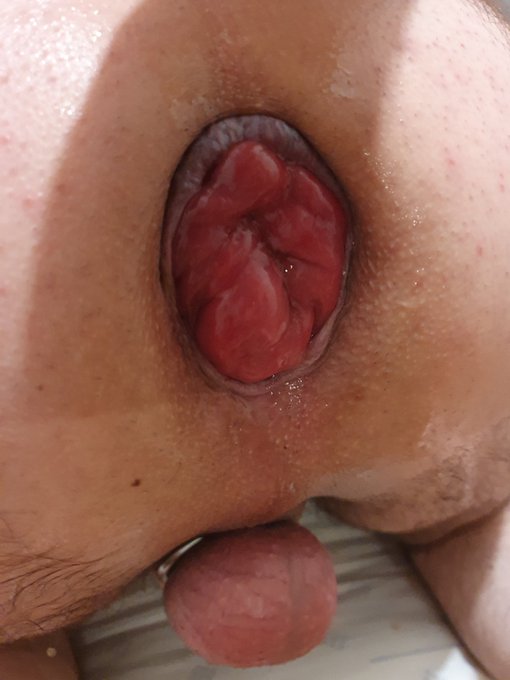 This was the result of pumping my prolapse for a while. #prolapse #rosebud #chastity https://t.co/US<a href="/tag/rosebud"class="tags"><span>#rosebud</span></a><a href="/tag/prolapse"class="tags"><span>#prolapse</span></a><a href="/tag/chastity"class="tags"><span>#chastity</span></a>