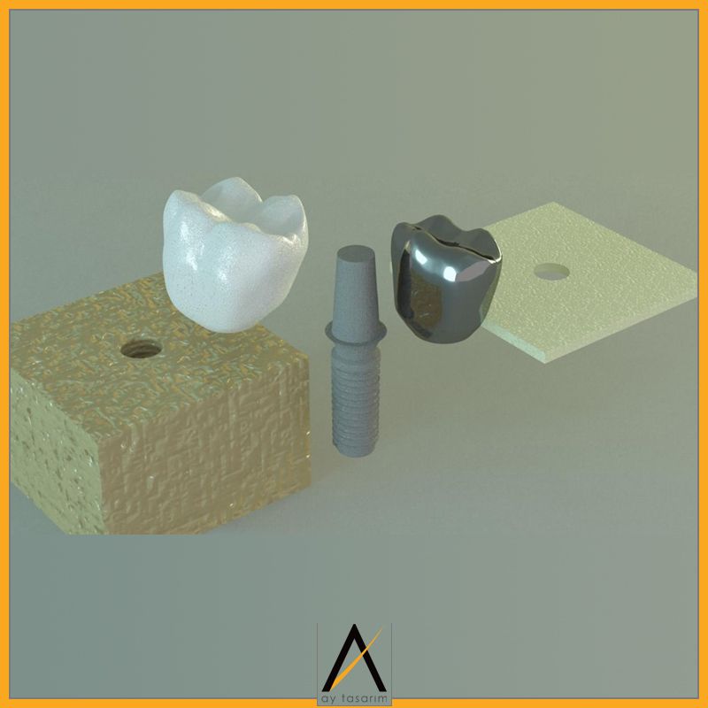 aytasarim's tweet image. Çalışma Adı: Dinamik yükleme yapılan kısa implantlarda kron/implant oranının stres dağılımına etkisinin incelenmesi
Doktor Adı: Ersan Çelik
#implantoloji #finiteelement #biomedical #3d #craniofacial #implant #3dmodelling #cad #computeraideddesign #dentist #dentistry