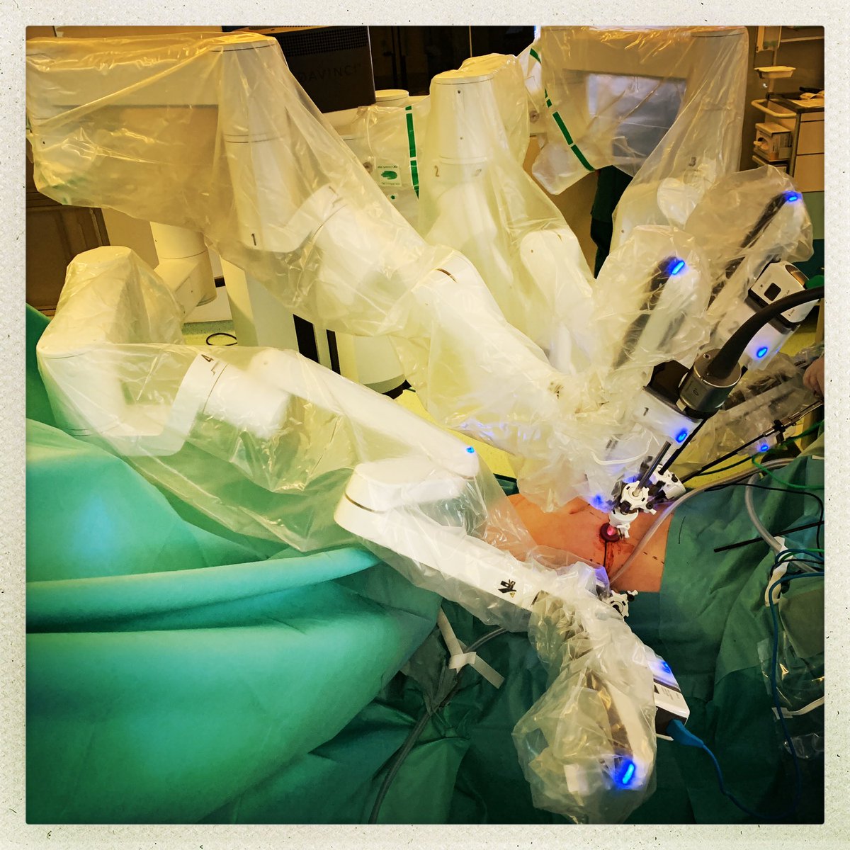trwherrmann's tweet photo. Today #robotic #RPLND for #NSGCT residual. thanks @JamesPorterMD for the #porting tips @SwedishMedical works well. @CEC_URO #STGAGwecare https://t.co/IomTf2qm0C