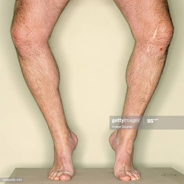 кривые ноги у мужчин.