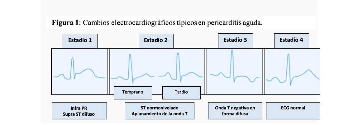 SIAC_cardio's tweet image. #Pericarditis #ECGfirst
@EmmanuelScatu 
#LideresEmergentesSIAC
siacardio.com/educacion/lide…