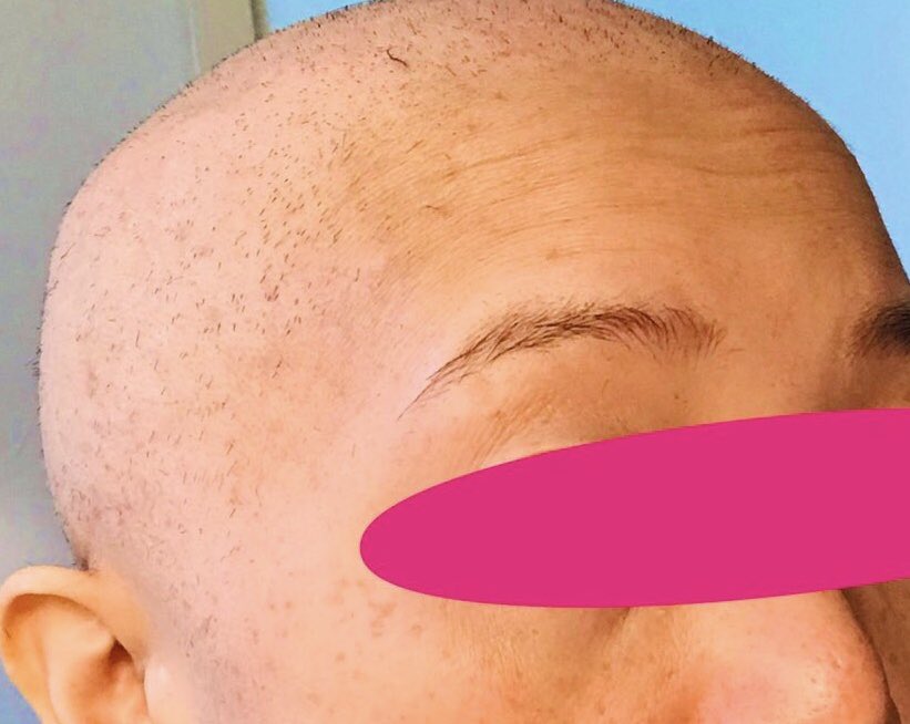 Haru 思い切ってバリカンでやっちゃいました 頭が痒くて赤いボツボツが出てきてたので 何塗っていいか分からないけど スッキリした