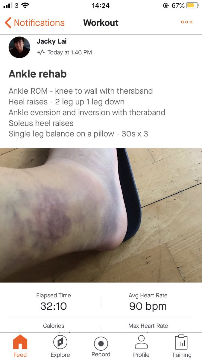 Day 3 - lateral ankle sprain update 

Such a chore doing your own rehab exercises 😭 
#ankleinjuries #atfl #physiotherapy #rehab #strava #garmin #gainz