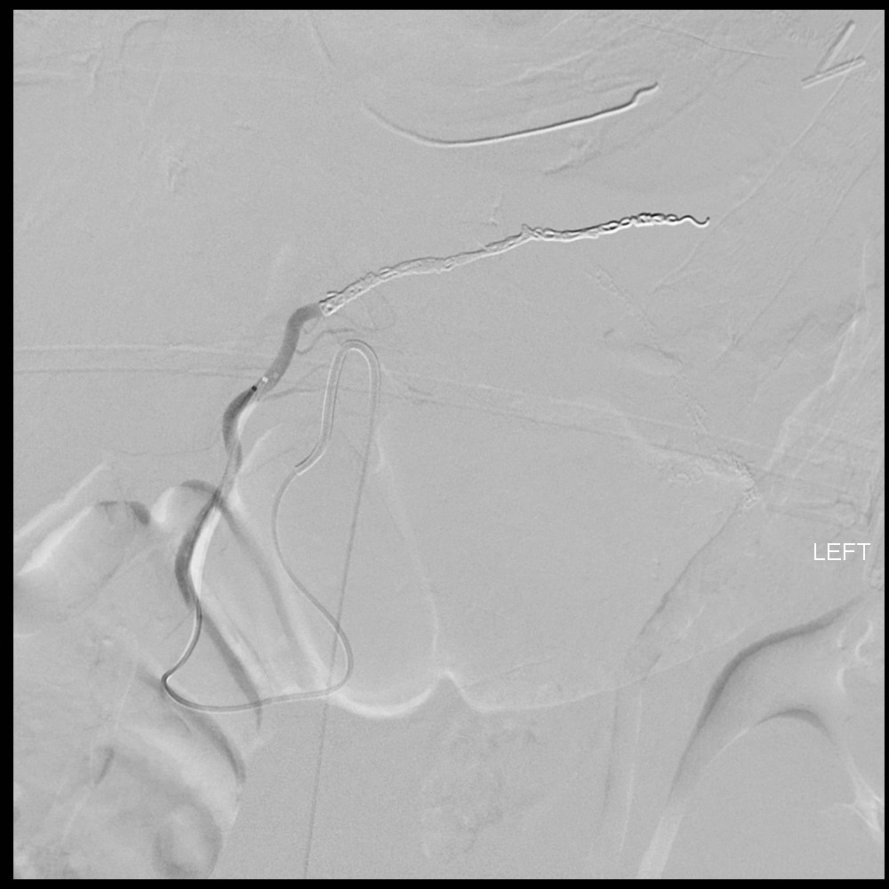 MUSC Interventional (@muscvir) on Twitter photo Sometimes you have to search a little further. Celiac and GDA angio with no evidence of bleeding, Injection of gastroepiploic demonstrates brisk active bleeding. Successfully treated with coil embolization. <a href="/BryanEAshley/">Bryan Ashley</a> Sometimes you have to search a little further. Celiac and GDA angio with no evidence of bleeding, Injection of gastroepiploic demonstrates brisk active bleeding. Successfully treated with coil embolization. <a href="/BryanEAshley/">Bryan Ashley</a>