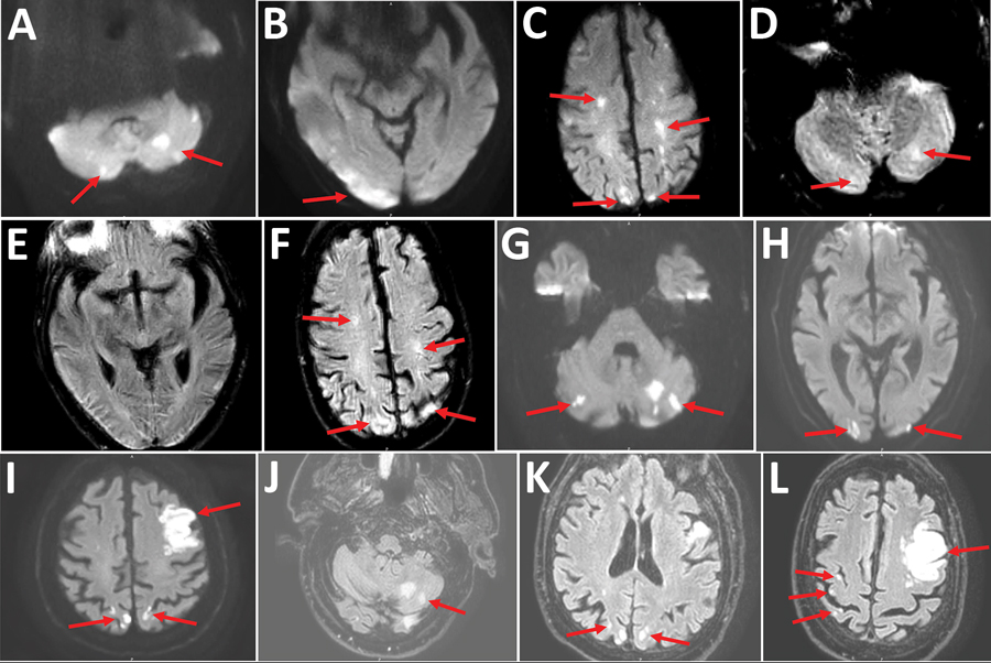 GlobalPHObserv's tweet photo. RT @CDC_EIDjournal: Acute cerebral stroke with multiple #infarctions and COVID-19, France, 2020, #EIDjournal, https://t.co/u6T6zTJbYN
(#CerebralStroke, #COVID19, #SARSCoV2) https://t.co/W5ZHgJGA0W