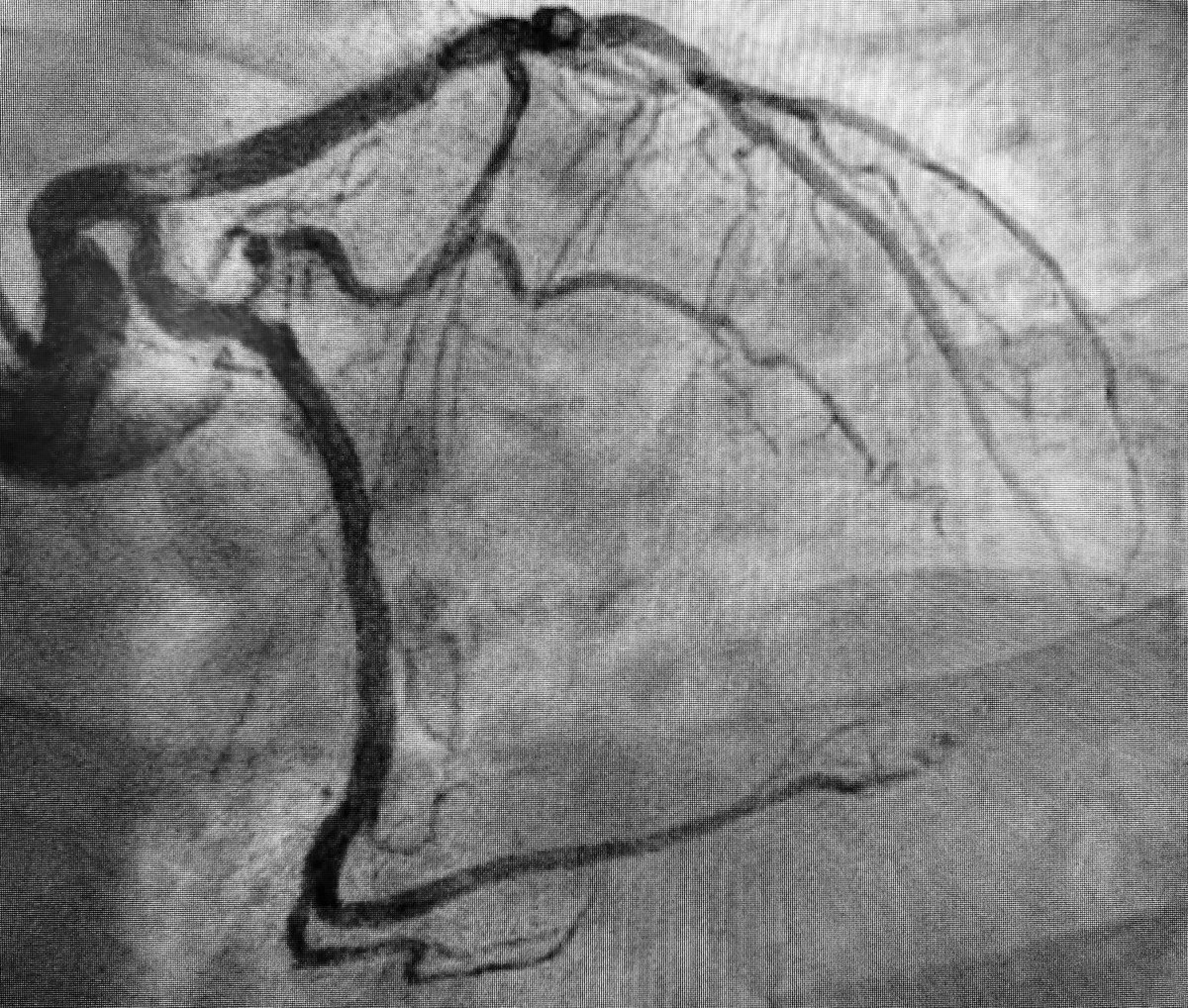 1/6  #SpokeAndHub  #Shock story: 50s Diabetes presents with acute chest discomfort/dyspnea. ECG global ischemia. HR 100s, BP 90s. Cath below at  #Spoke Hospital. EF 45% by LV Gram...