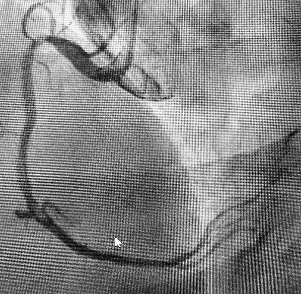 1/6  #SpokeAndHub  #Shock story: 50s Diabetes presents with acute chest discomfort/dyspnea. ECG global ischemia. HR 100s, BP 90s. Cath below at  #Spoke Hospital. EF 45% by LV Gram...