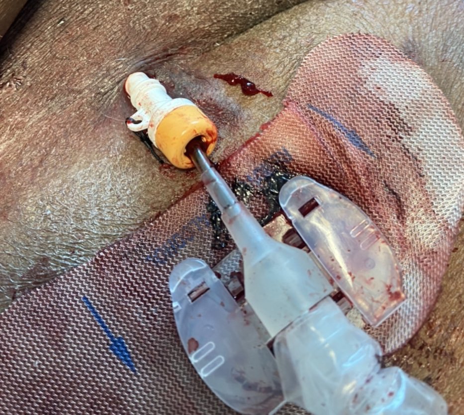 3/6 Femoral swan out during xport. IABP site bleed in  #CICU: unsuccessfully tx with FemStop but successfully (and easily) tx bedside with minimal forward sheath advancement ( #ProTip [below] courtesy of  @J_M_McCabe). In interim: pressors piled on/mode of revasc “reconsidered”...