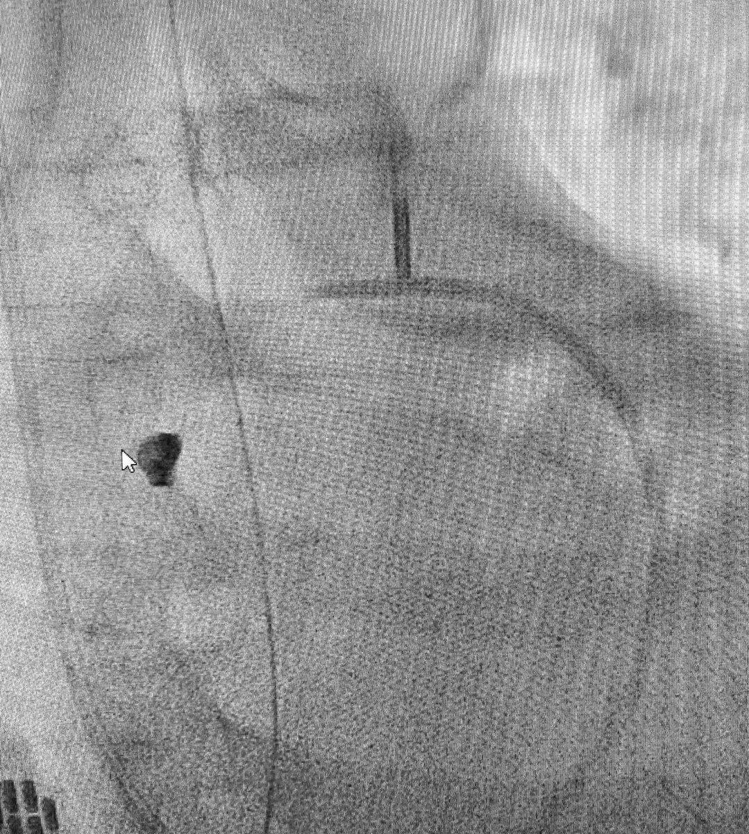 4/6 Back to Lab (with Surgeons in control room for  #MultiDisciplinary chat). New Swan in (IJ). Swan/hemodynamic-guided volume (blood/IVF) resuscitation and down-titration of pressors (to nearly zero) in Cath Lab. IABP repositioned. Repeat angiography...