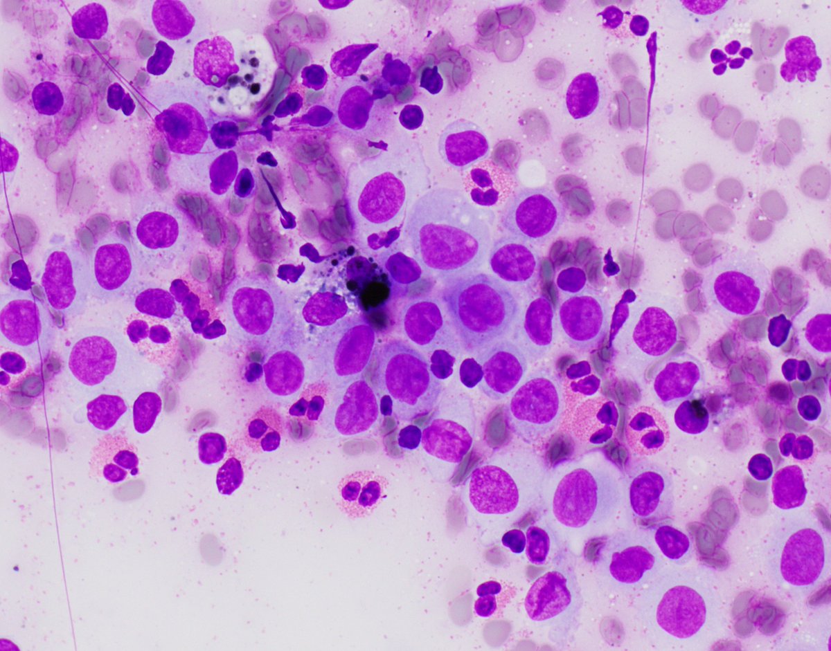 HubertLauMD's tweet image. As I finish my morning coffee...

#FNApath #Cytopath #BSTpath #Hemepath