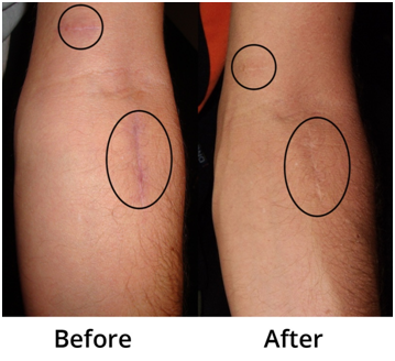 PainExpertKelly's tweet photo. MPS Scar/Adhesion Release Therapy significantly reduces the restrictions of scar tissue.

https://t.co/o12ny6PSfj https://t.co/CTD9H5yDvS