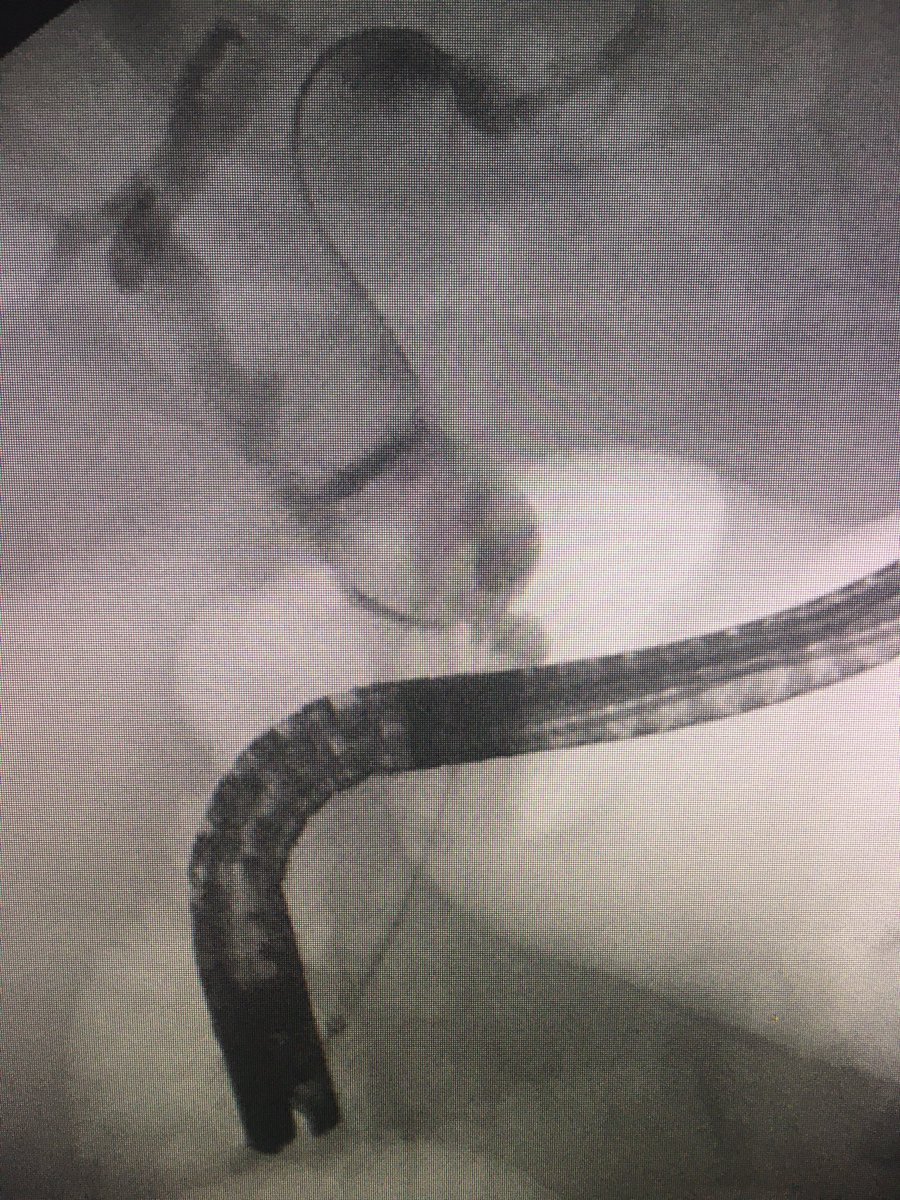 ChahalPrabhleen's tweet photo. Post OLTx, anastomotic stricture and large rocks extending till bifurcation in the donor bile duct . Lot of chiseling/ crushing/chipping/blasting along with covered SEMS / long plastic through it across stricture . These are tough/ long cases . https://t.co/XrpA5rF8Yp