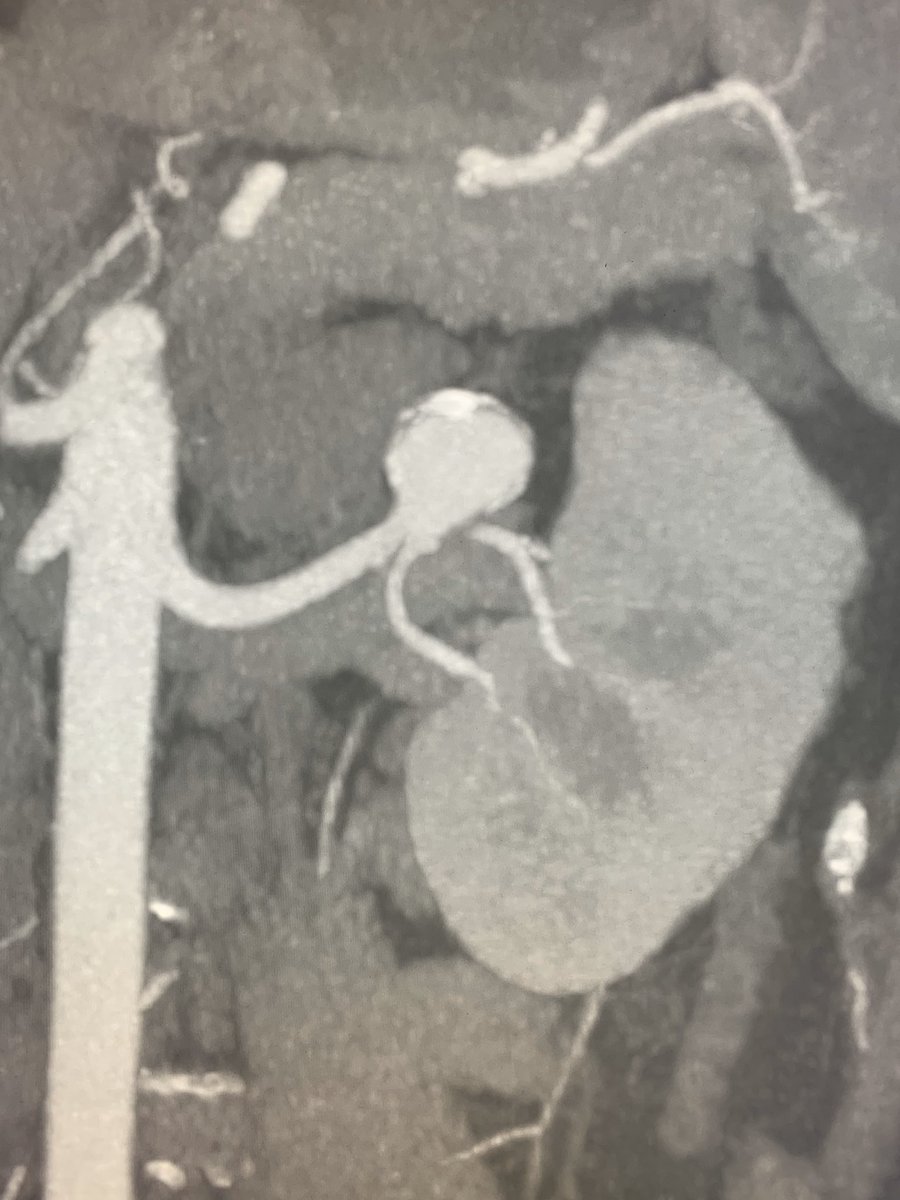 eliebalesh's tweet photo. Enlarging 2x2x2 cm left renal artery aneurysm with 7 mm neck. Framed 1:1 with @PenVascular complex standard Ruby coil. Filled with complex soft Ruby & Pod Packing coils for complete exclusion. #IRad https://t.co/8yA6LsMTew