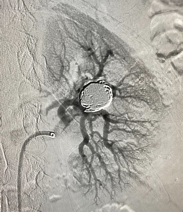 eliebalesh's tweet photo. Enlarging 2x2x2 cm left renal artery aneurysm with 7 mm neck. Framed 1:1 with @PenVascular complex standard Ruby coil. Filled with complex soft Ruby & Pod Packing coils for complete exclusion. #IRad https://t.co/8yA6LsMTew
