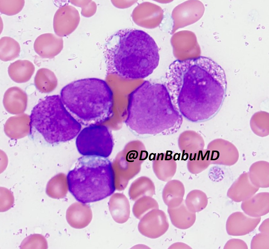 DanBabuMD's tweet photo. It's well-known that B-lymphoblastic leukemia can rarely have granules, but I've never seen one so intensely granular as this! MPO negative with straightforward precursor B-cell phenotype by flow. Young adult patient. #hemepath https://t.co/0xy2pKdjoh