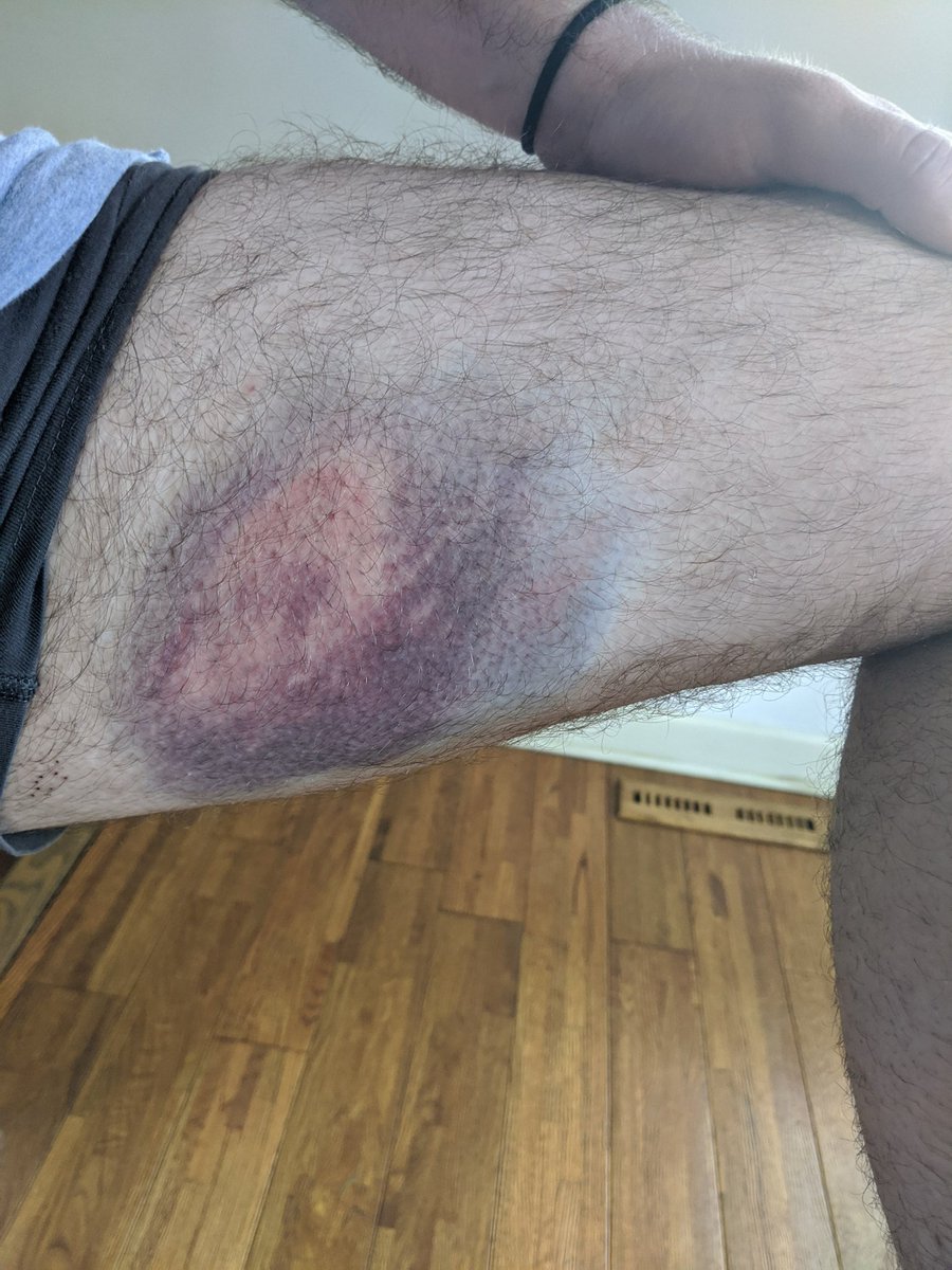 AndrewMannix's tweet photo. Here's my leg today. This is from a non-lethal projectile, fired by Minneapolis police while I covered protests of #GeorgeFloyd last night. Stay safe folks https://t.co/4uuVgt3mX3