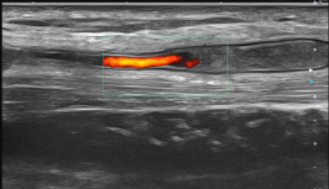 inigoiri's tweet photo. Weekly case: Male 52 y, on february progressive fast onset of pain without any identified cause in left upper limb located in medial side of wrist, forearm and elbow, increasing with direct palpation. Subjective swelling sensation (not corraborated at consultation) https://t.co/dNE5qyChiz