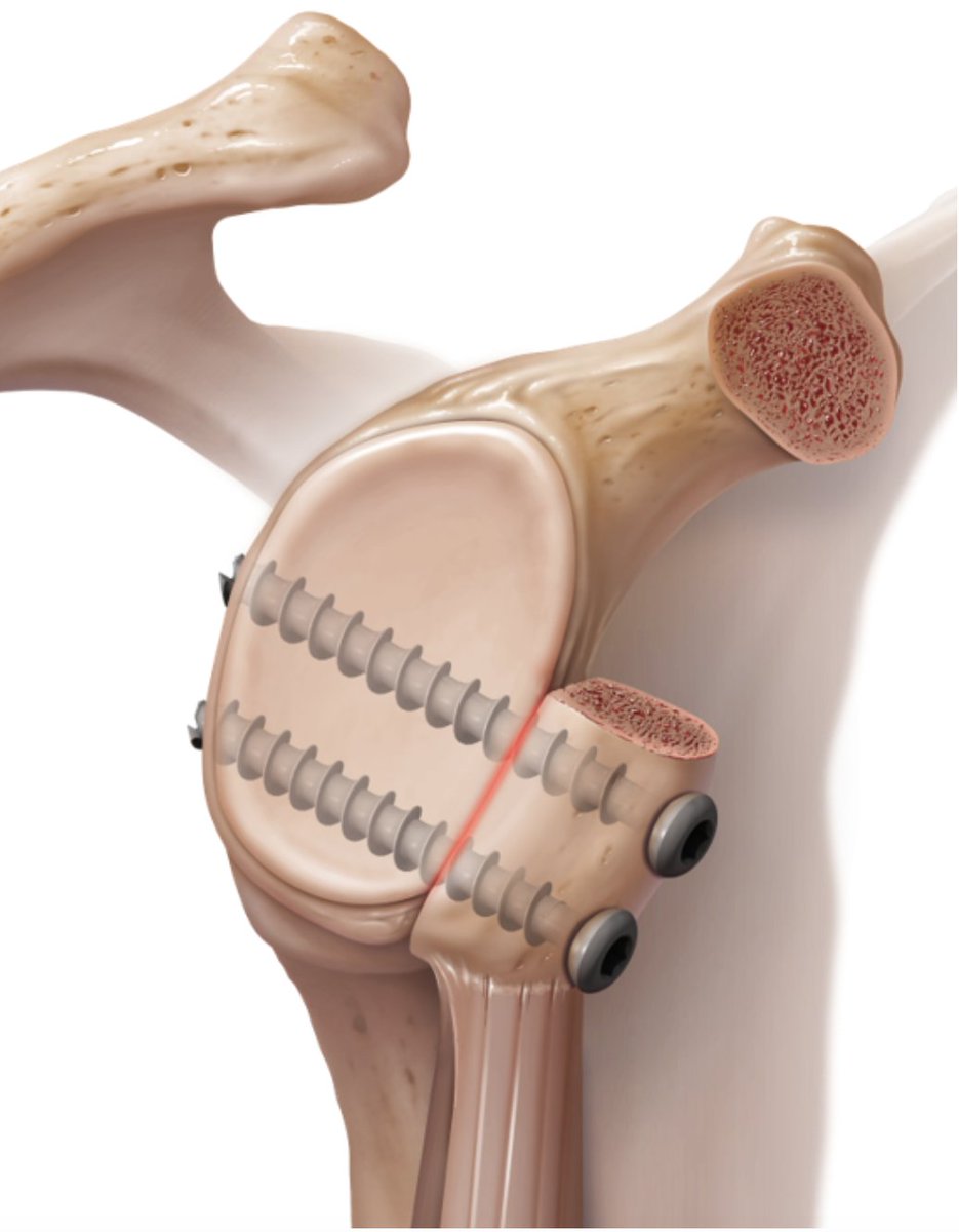 MillettMD's tweet image. In this video, Dr. Peter Millett demonstrates a #LatarjetProcedure. This procedure is used as a #ShoulderInstability treatment. medilink.us/4rpg #MedTwitter