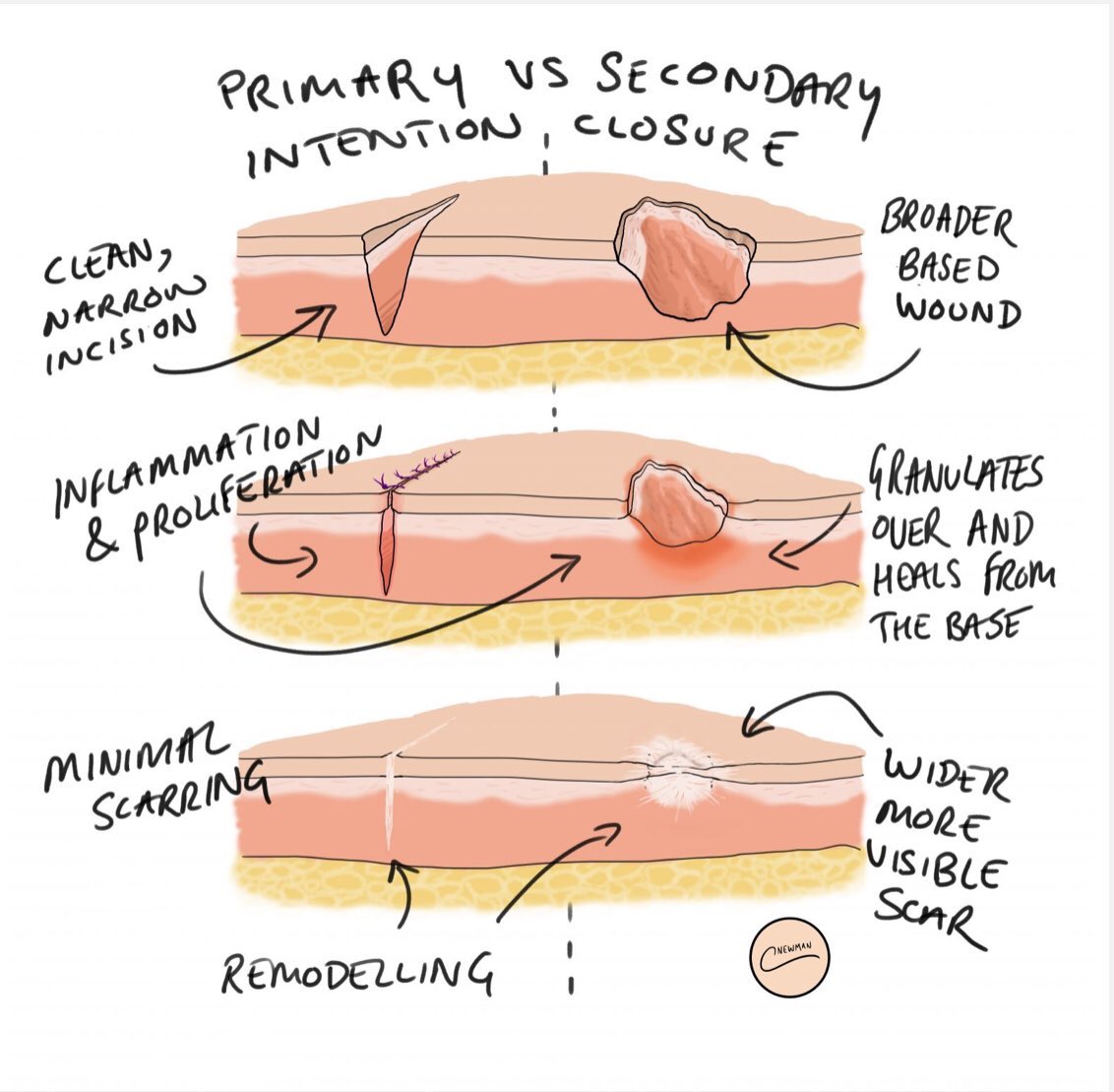 The acute inflammatory initial stages are often known but many people forget that inflammation response if more about protection initially ie like calling 911 the SWAT team, Police, ambulance and Fire truck arrive, this is to ward of invaders and clean the area and make sure...