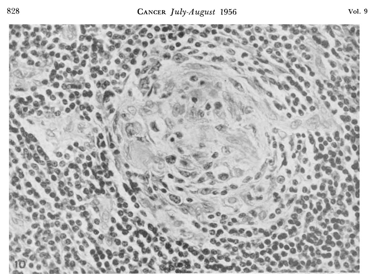 Castleman argued against their thymic or neoplastic origin. The nodes were highly vascular with marked capillary proliferation with hyaline thickening of the vessel walls penetrating the follicles (left), resembling Hassall corpuscles (right).