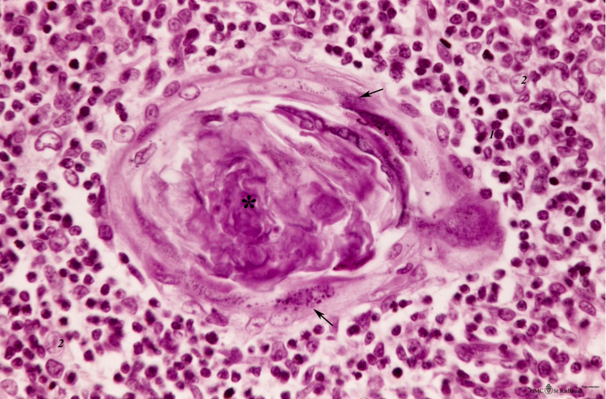 Castleman argued against their thymic or neoplastic origin. The nodes were highly vascular with marked capillary proliferation with hyaline thickening of the vessel walls penetrating the follicles (left), resembling Hassall corpuscles (right).