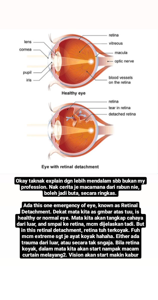 Kalau retina menipis, apa akan jadi? Banyak, if im not mistaken. But one of the emergency in the eyes adalah this one condition named Retinal Detachment. Bila you punya retina makin menipis, chances untuk retina tuh koyak and then detached akan lebih tinggi.