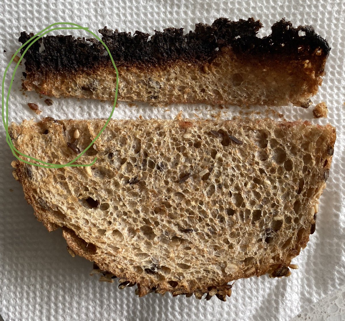 BURNOMA. Typical location (Toast).Left resection margin <0.1 cm.Prognosis: excellent  #pathtwitter  #pathology  #toastpathology