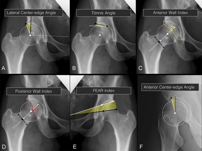 #FreeinCORR Periacetabular Osteotomy Improves Pain and Function in Patients With Lateral Center-edge Angle Between 18° and 25°, but Are These Hips Really Borderline Dysplastic?
ow.ly/PJWs50zSqXH
IMAGE: Measurements to assess acetabular morphology and femoral head coverage