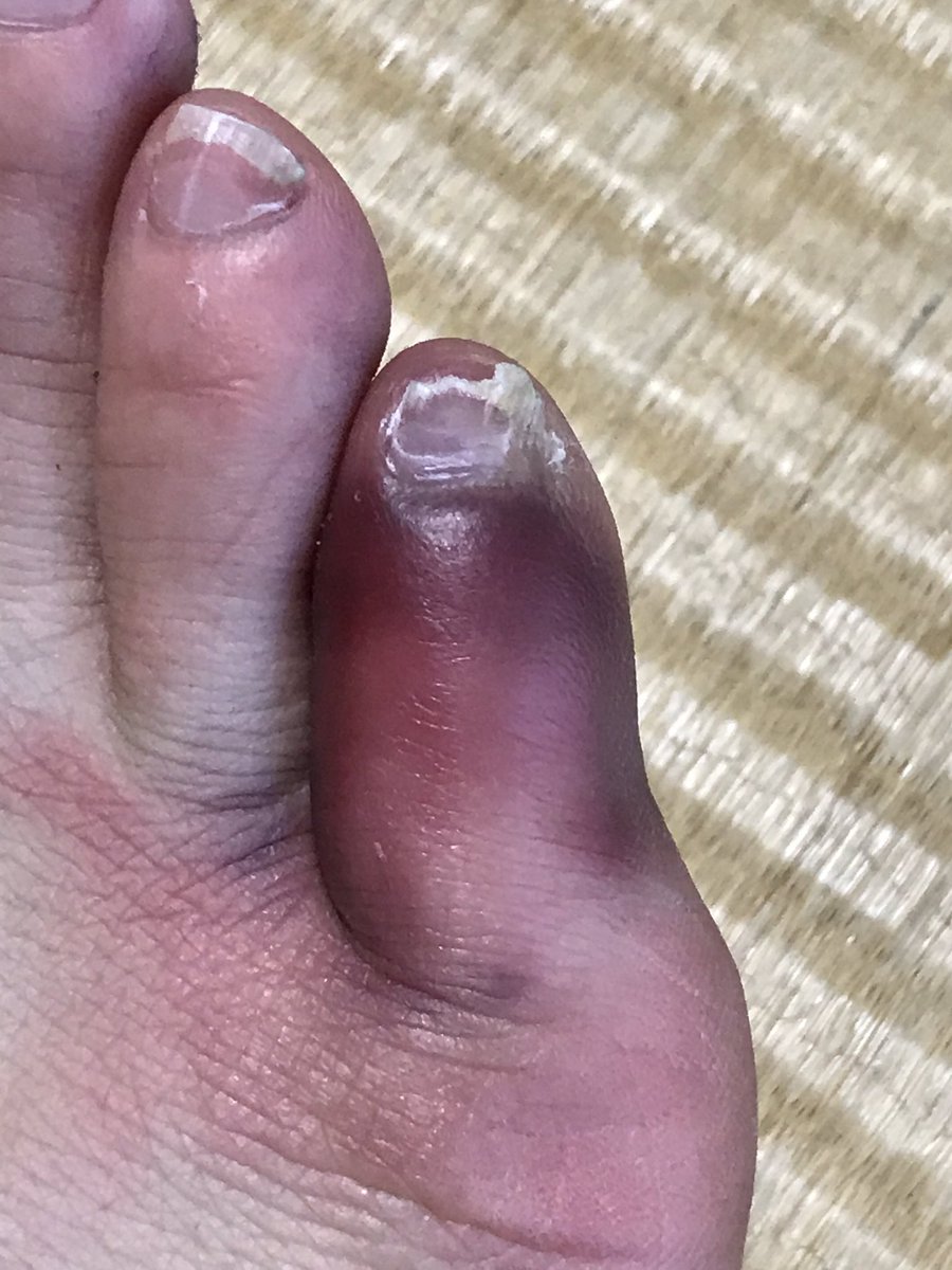 Shimizu Daisuke Twitterissa マジで医者行った方がいいですよ ウチの父も小指ぶつけて内出血して念の為医者行ったら折れてましたから Shimizu Daisuke Twitterissa マジで医者行った方がいいですよ ウチの父も小指ぶつけて内出血して念の為医者行ったら折れてましたから