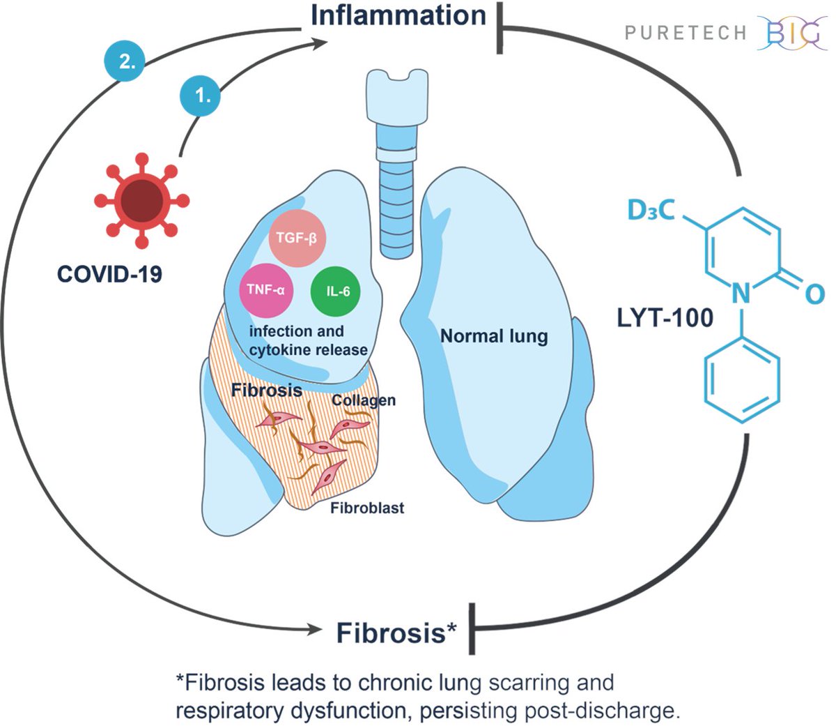 PureTechH's tweet photo. Many of the millions infected with #COVID19 may be at risk for serious respiratory complications post recovery. We plan to advance our wholly-owned clinical candidate in a global, randomized, placebo-controlled trial https://t.co/hVaIWFYxNX https://t.co/D8mAe00Lr0