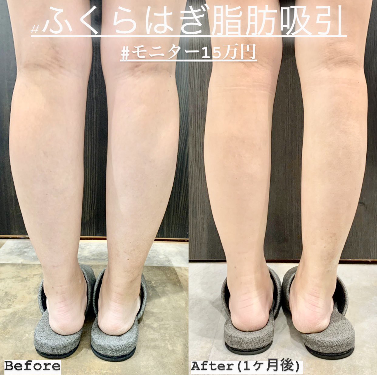糸リフト 二重整形 鼻整形 ルラ美容クリニック院長 武内大 ふくらはぎ脂肪吸引 1ヶ月後経過 モニター価格15万円 ふくらはぎの脂肪吸引の1ヶ月後経過です ふくらはぎの脂肪をしっかりと除去しております ふくらはぎの脂肪吸引の特別モニター価格