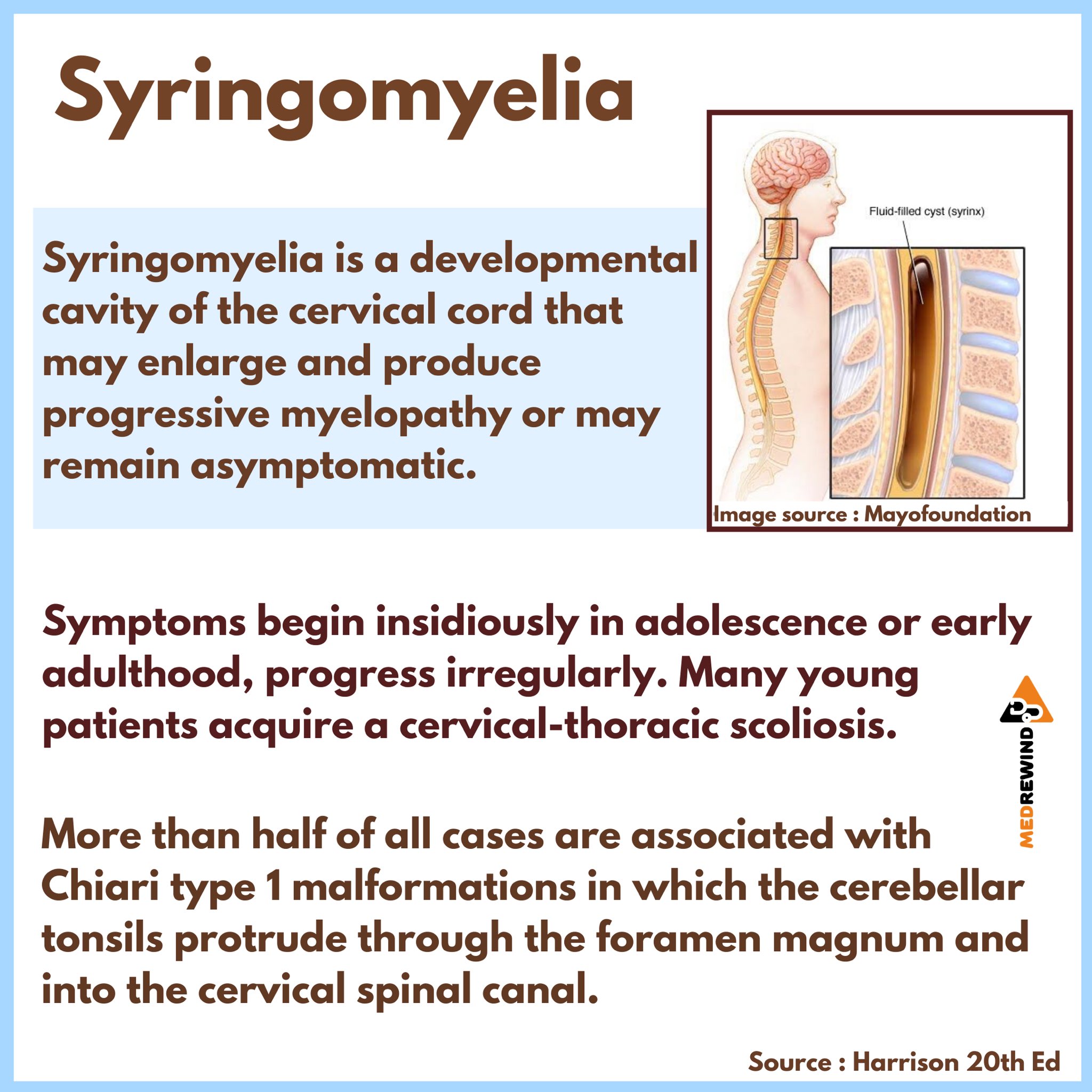 Syringomyelia Spinal Cord