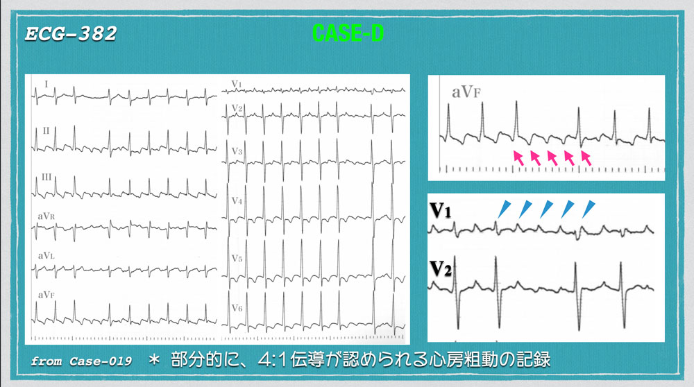 心電図 フラッター 心電図のフラッターとフィブリレーションの違いを教えてください。