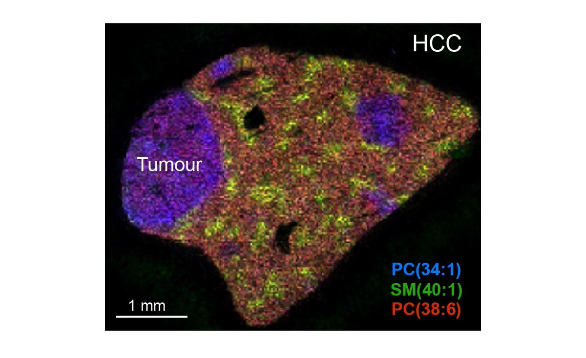 Delighted to share our multi-omics study in @HEP_Journal on how proliferating hepatocytes rewire #metabolism in #liver #regeneration and #HCC. @julesgrif @MikeVacca1979 @CamBiochem @ImperialMDR @TVPLab @FibrosisLab @QAnstee @Matt_Hoare20 @The_MRC  

pubmed.ncbi.nlm.nih.gov/32460431/