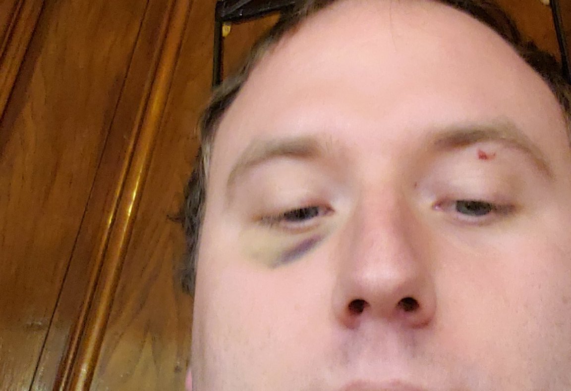 The campaign is long and sometimes you have to make it happen when you aren't at your best. Staffing Joe with a black eye I got in Jiu-Jitsu class earned me some curious stares. It also inspired Sean from  @Teamsters25 to remark, "You're supposed to duck, knucklehead". /7
