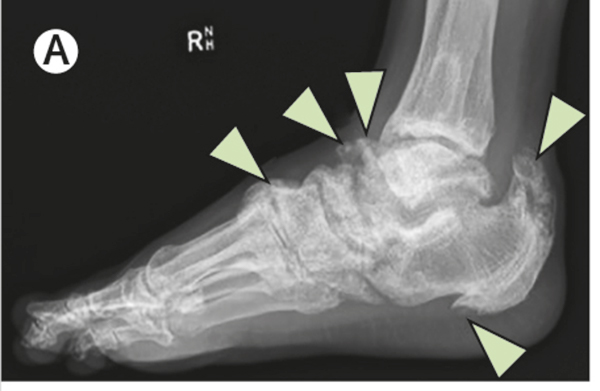 a ii fokú talus navicularis ízületi arthrosis)