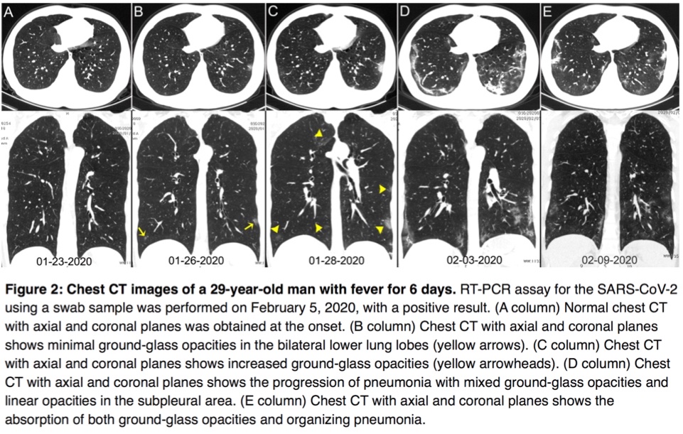 SPEED: PCR test results typically take several days (fast PCR tests have even worse false negative rates). CT-scans take seconds, results can be available within minutes. Typical pattern looks like ground glass in the lung(Images paper Ref 1, and healthy lungs)4/9