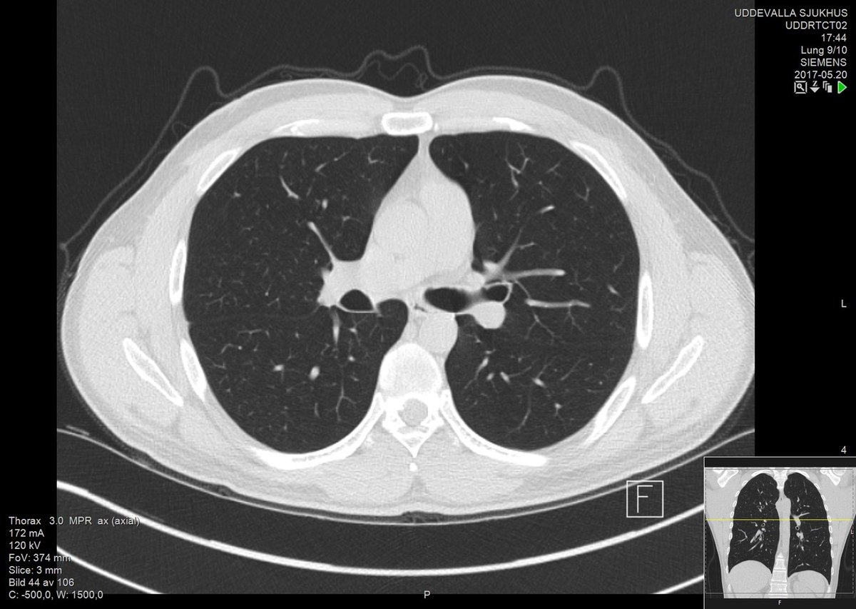 SPEED: PCR test results typically take several days (fast PCR tests have even worse false negative rates). CT-scans take seconds, results can be available within minutes. Typical pattern looks like ground glass in the lung(Images paper Ref 1, and healthy lungs)4/9