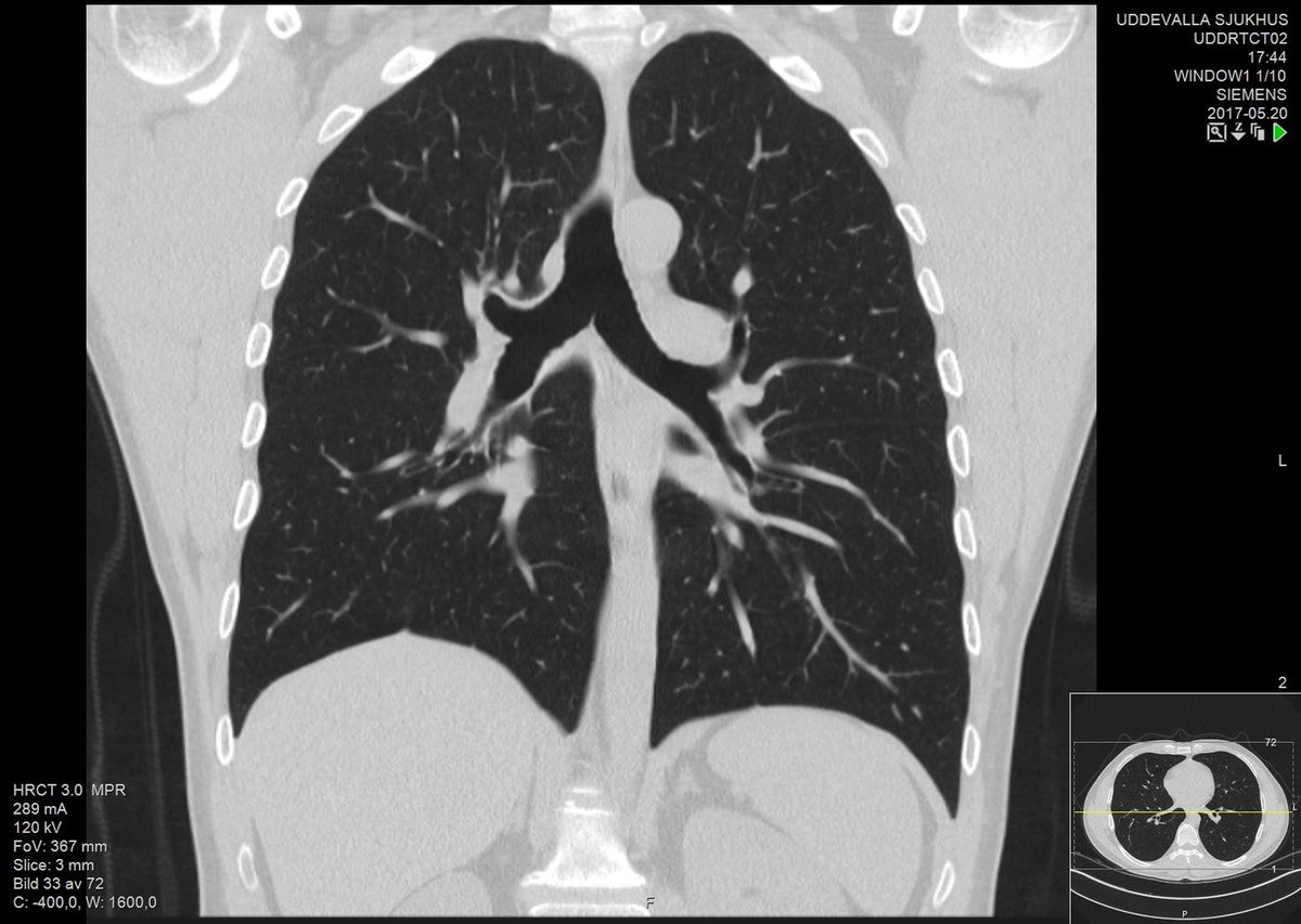 SPEED: PCR test results typically take several days (fast PCR tests have even worse false negative rates). CT-scans take seconds, results can be available within minutes. Typical pattern looks like ground glass in the lung(Images paper Ref 1, and healthy lungs)4/9