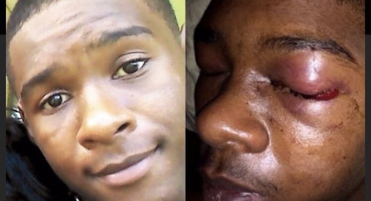 Dafonte Miller was beaten with a steel pipe by 2 Toronto Officers Michael and Christian Theriault that left him with life-altering injuries. He was 19. (2017)
