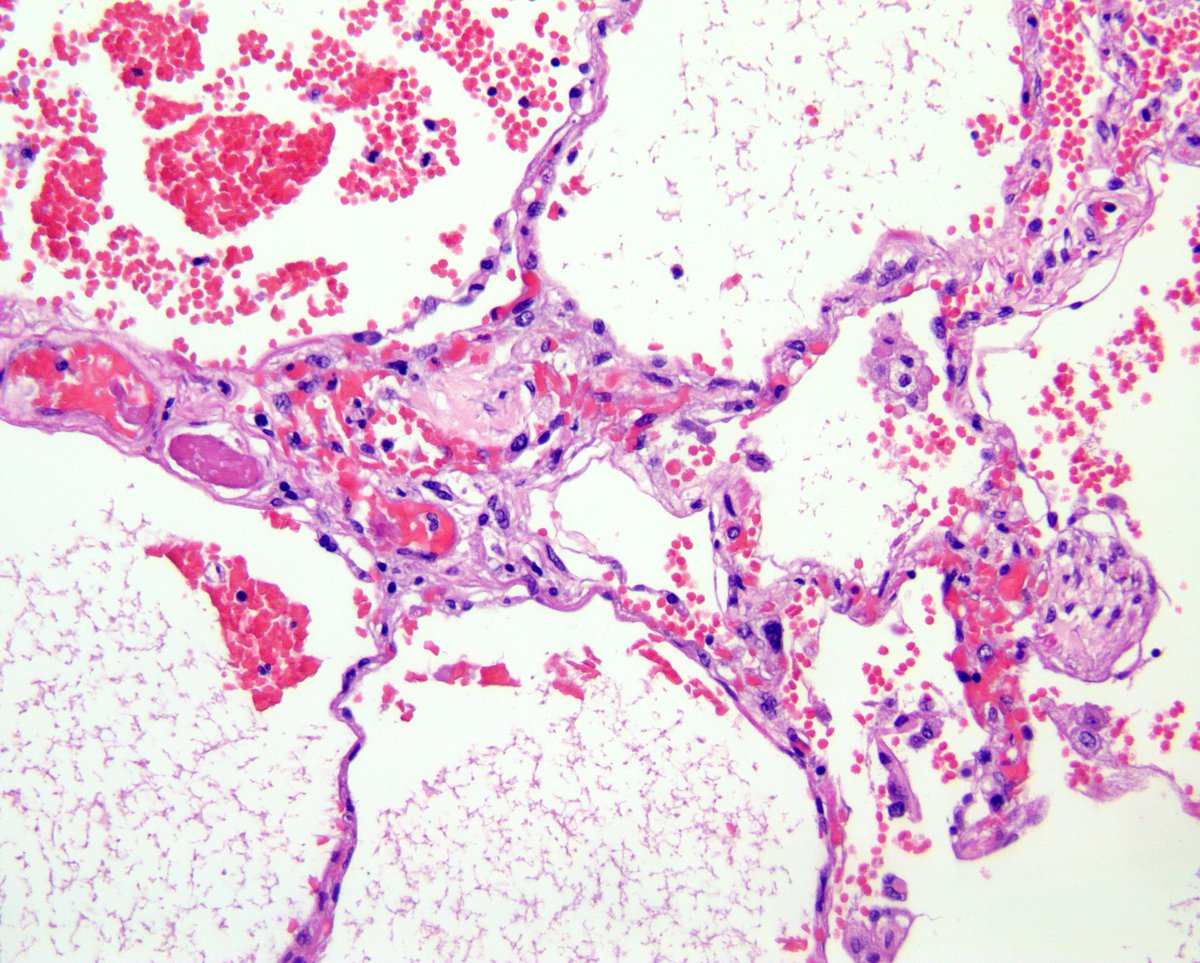 Esta neumonitis intersticial por COVID-19 puede estar acompañada de trombos de fibrina en pequeños vasos con hemorragia asociada en la periferia pulmonar y también en grandes vasos