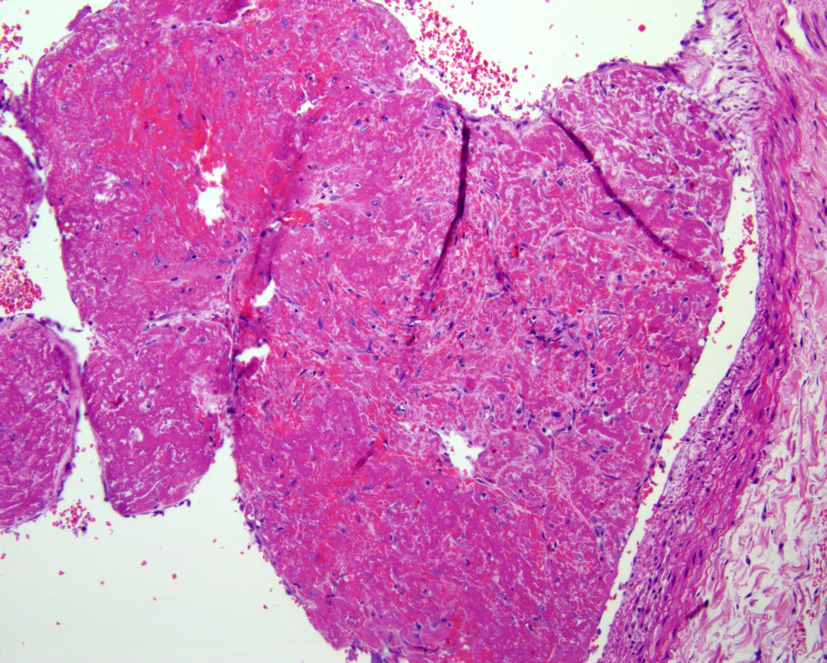 Esta neumonitis intersticial por COVID-19 puede estar acompañada de trombos de fibrina en pequeños vasos con hemorragia asociada en la periferia pulmonar y también en grandes vasos