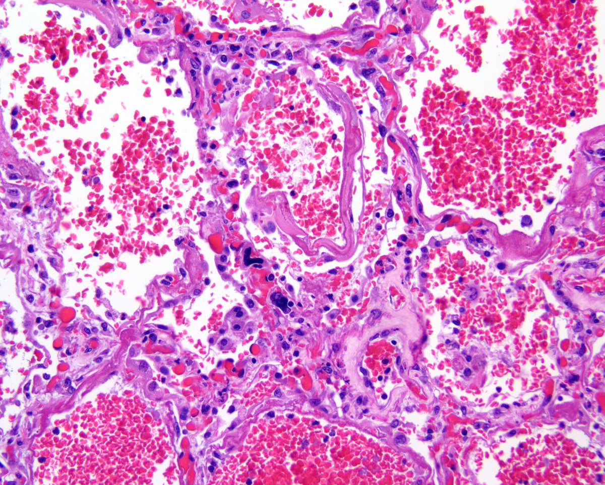 Patológicamente, la neumonía COVID-19 congestión, infiltración celular inflamatoria y formación de membrana hialinas