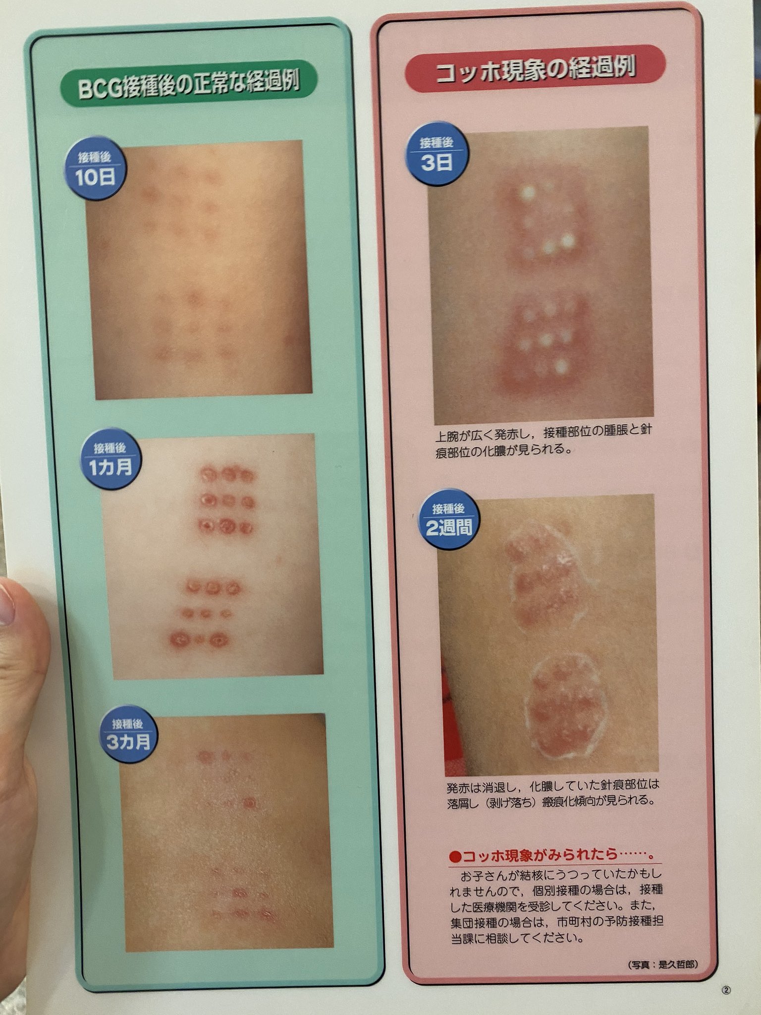 ぽてと 1y Sur Twitter 先日bcg受けたんですが 病院で説明受けたコッホ現象の膿みたいまではなってないけど 当日夜から赤く腫れてきて 普通腫れるもんだろって思ってたんですがよく説明見たら10日後からやっと赤みが出てくるのが正常なんですよね そのことに ぽてと 1y Sur Twitter 先日bcg受けたんですが 病院で説明受けたコッホ現象の膿みたいまではなってないけど 当日夜から赤く腫れてきて 普通腫れるもんだろって思ってたんですがよく説明見たら10日後からやっと赤みが出てくるのが正常なんですよね そのことに
