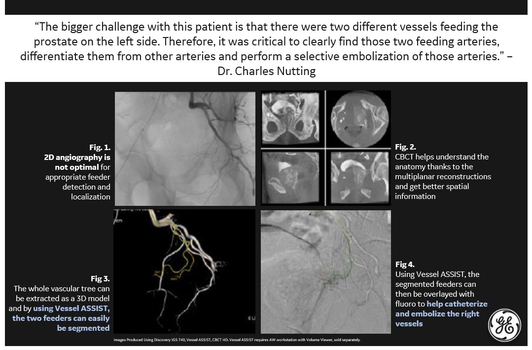 Using advanced imaging techniques [in this case, GE’s CBCT and Vessel ASSIST] allows me to treat my patients with more confidence, using less contrast and dose." Dr. Charles Nutting. Read More on Pg 41 : tiny.cc/zlkvpz 
#GEPartnersinPractice #IRad #PAE
