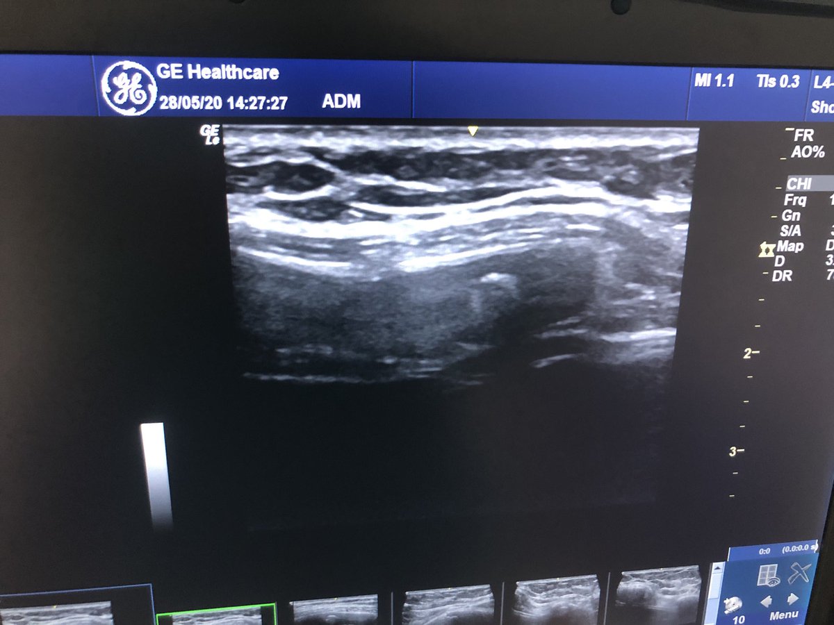 machofisio's tweet photo. Nuevo caso de Dx diferencial. Paciente que acude con dolor costal. Imagen ecográfica  hiperecogénica que confirma mediante Rx caso de calcificación de cartílago costal y lesión de partes blandas. #nofracturanofisura #ecografia ⁦⁦⁦⁦@primfisio⁩ @centrosanttelm https://t.co/Ot2GhT1xxR