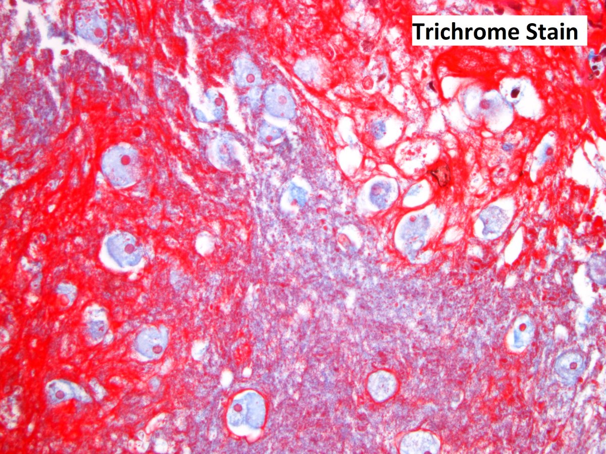 Textbook case of intestinal #amebiasis: 
Biopsies taken from a colon with many ulcers displaying "poached egg" appearances. Histologic examination shows the presence of E. histolytica in both  trophozoites and cysts form. #PathTwitter #GIpath #microbiology #pathharryspotter