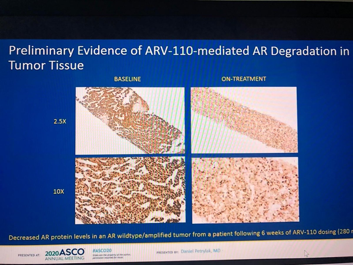  $ARVN platform by definition relies on AR degradation. However in  #ASCO20 deck their *representative* degradation slide is for wild type patient. While the 2 PSA50 responses were both mutants.So no correlation of degradation to tumor response?