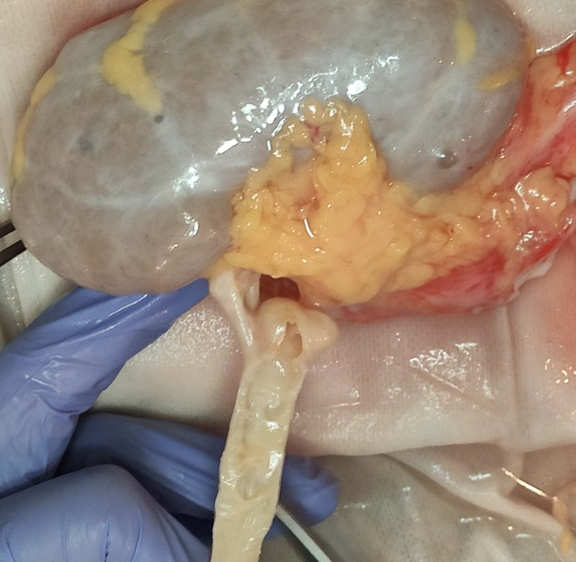 rojo_esther's tweet photo. Renal artery aneurysms in a cadaveric donor kidney. While preparing the kidney, we found 1 saccular thin walled aneurysm and other bigger close to the hilum. Impossible to reconstruct. The kidney was not used for transplantation.@Urologia12 @TrasplanteAEU #urosome https://t.co/MoyAfOhYY4
