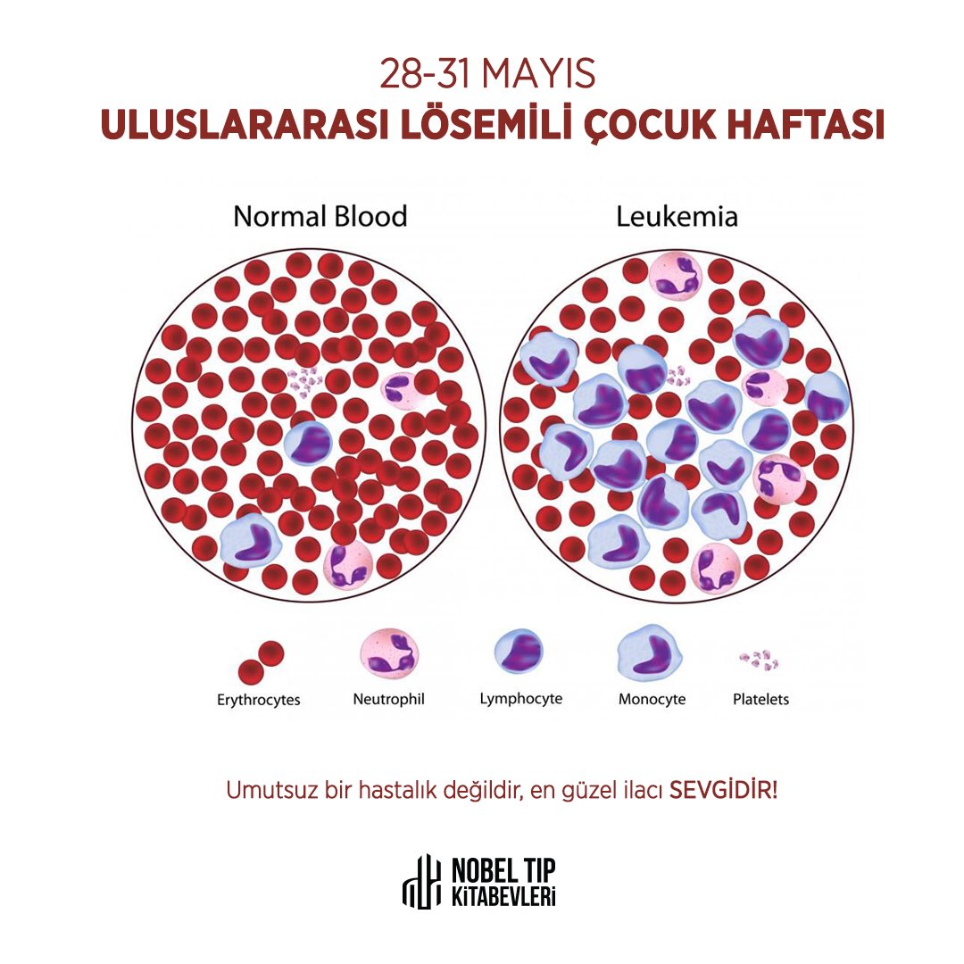 Рак крови диагнозы. Острый лейкоз мазок крови. Кровь больного лейкемией. Заболевание крови лейкемия.
